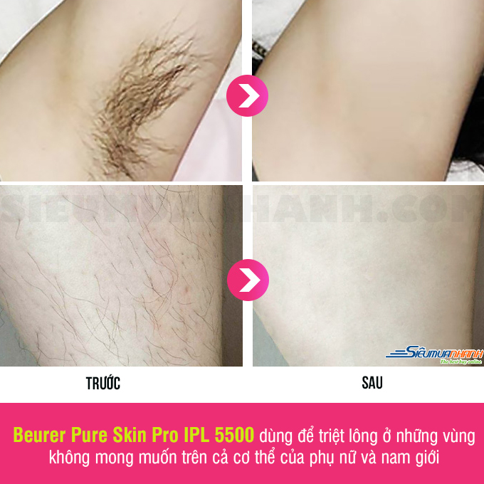 Máy triệt lông Beurer Pure Skin Pro IPL 5500